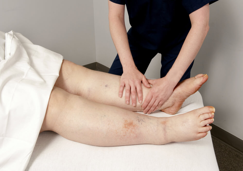 Treatment for lymphedema in New Bern, NC shutterstock 564749302 treatment for lymphedema